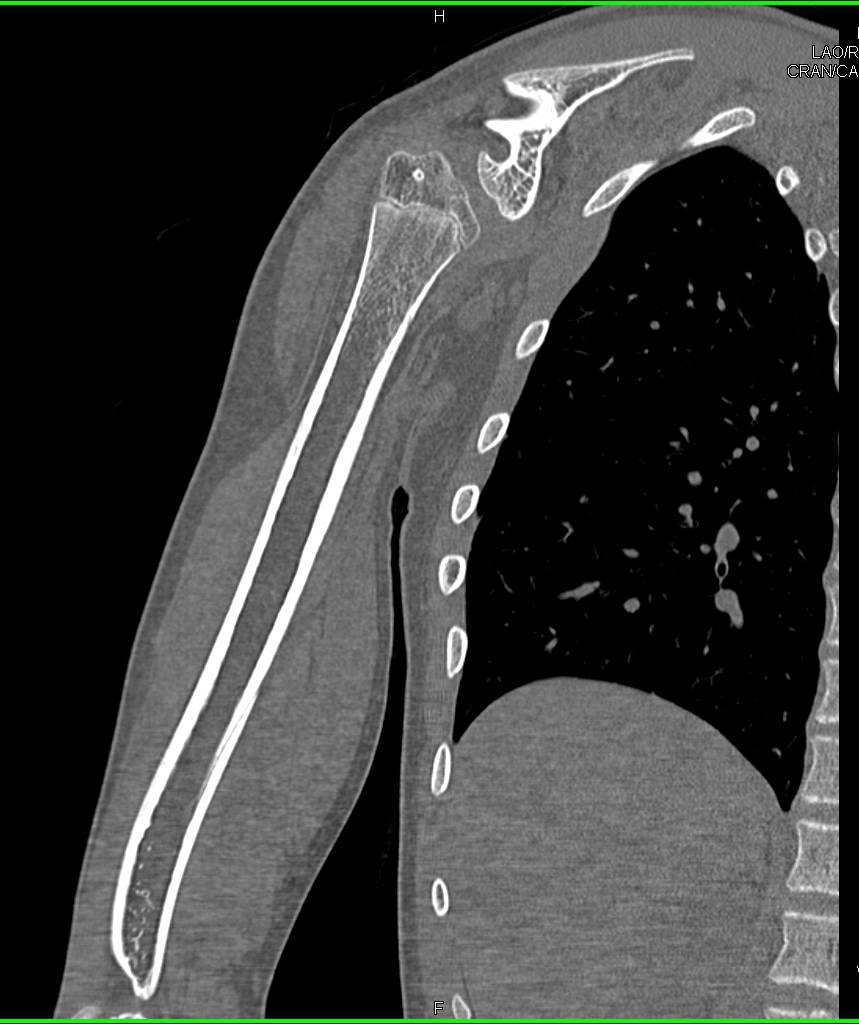 Dysplastic Shoulder with Deformed Glenoid and Humerus Head - CTisus CT Scan