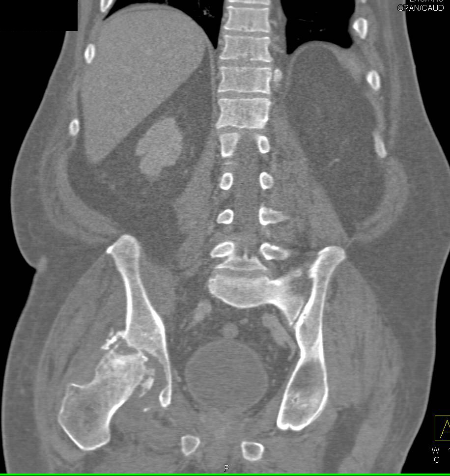 Avascular Necrosis (AVN) Right Hip with Subchondral Collapse and Joint