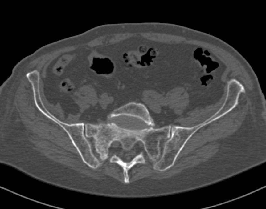 Stress Fracture of the Sacrum - CTisus CT Scan