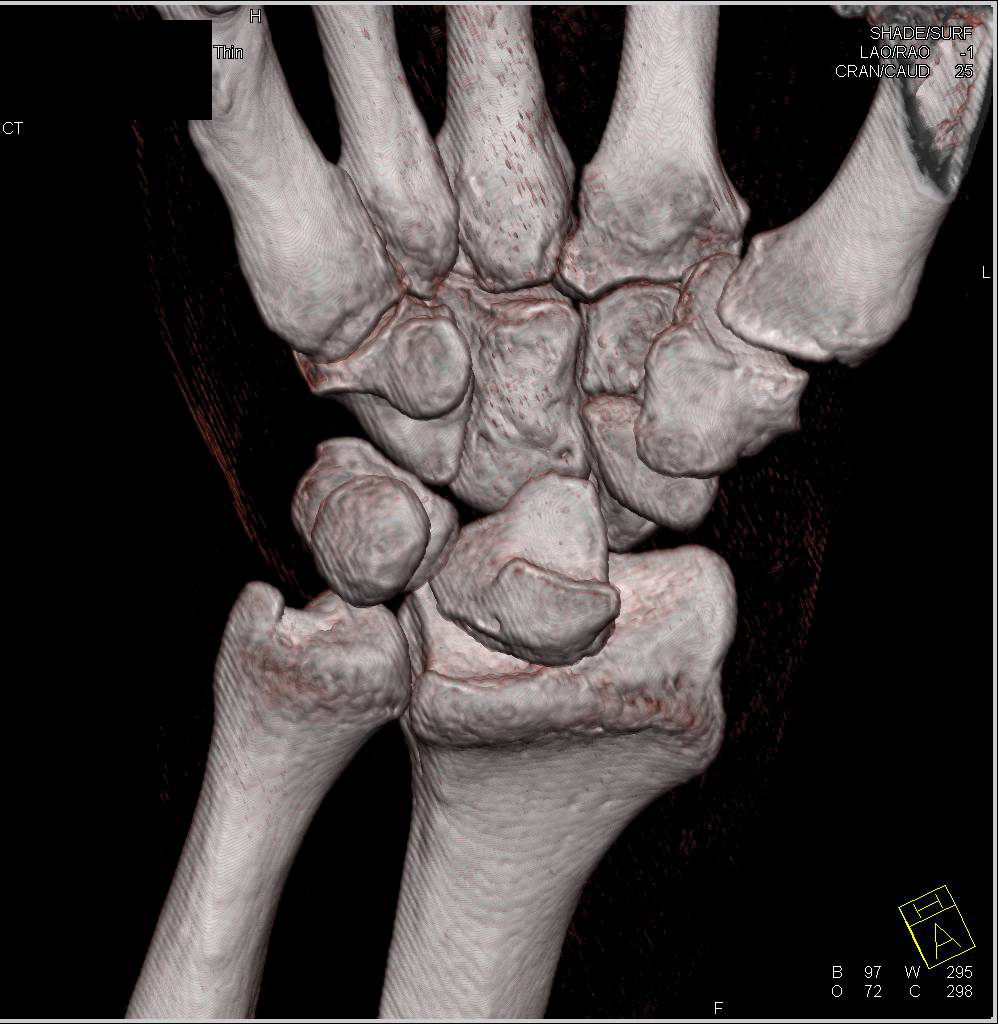 3D Imaging of the Wrist with Lunate Dislocation - CTisus CT Scan