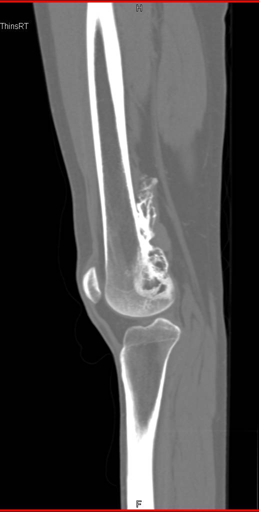 Exostosis off the Distal Femur - CTisus CT Scan