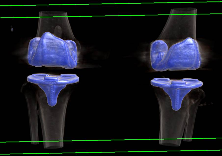 3D Mapping of Bilateral Total Knee Replacements - CTisus CT Scan