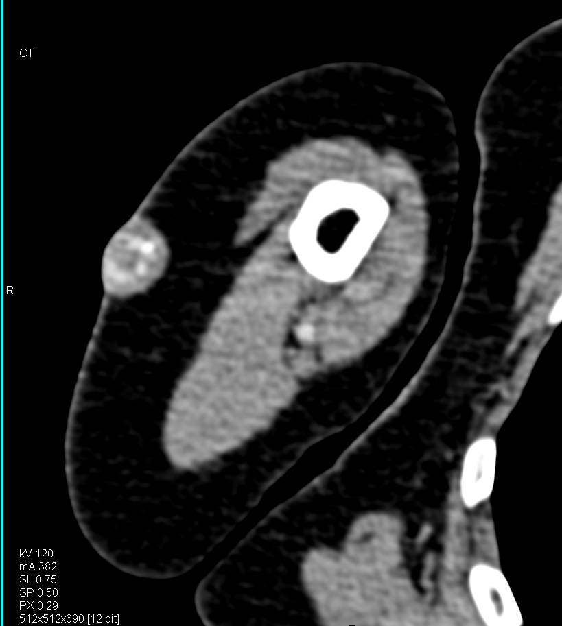 Partially Calcified Subcutaneous Nodule - CTisus CT Scan