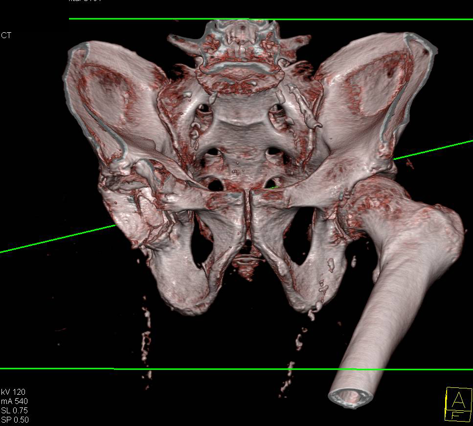 Acetabular Fracture with Hip Disarticulation - CTisus CT Scan