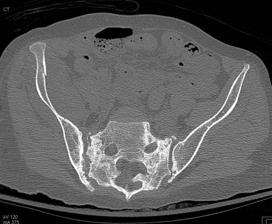 Sacroiliitis - CTisus CT Scan