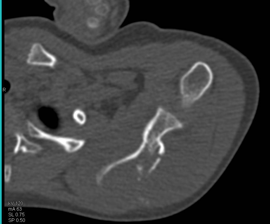 Ewing Sarcoma of the Scapula - CTisus CT Scan