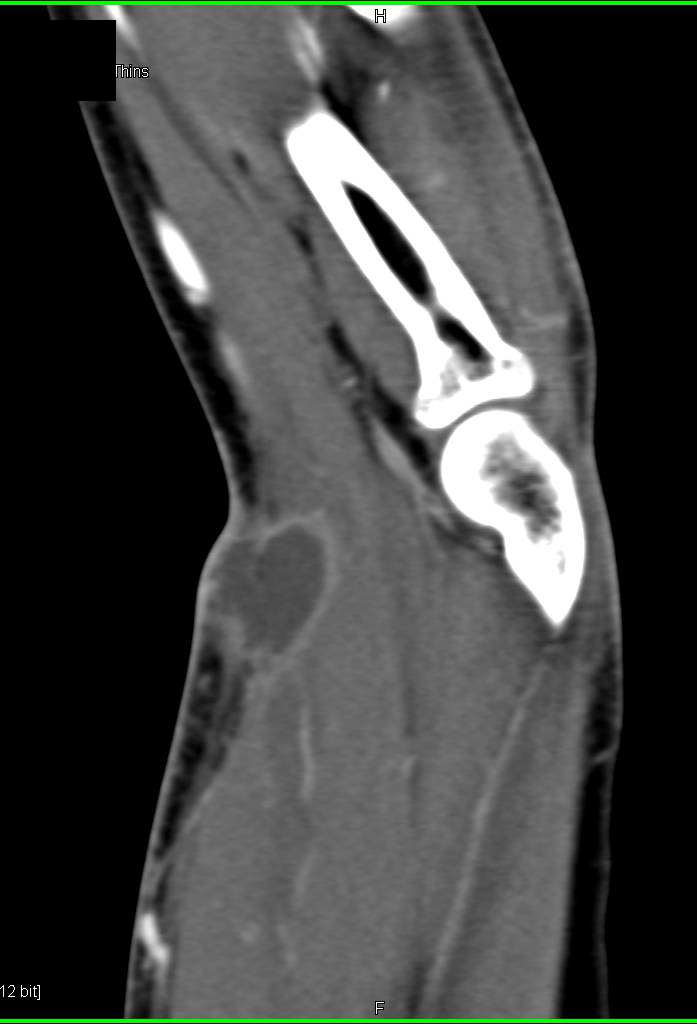 Abscess in Antecubital Fossa - CTisus CT Scan