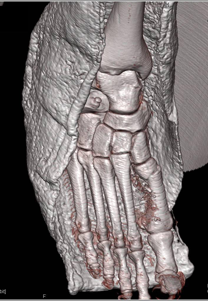 Fracture of First Metatarsal - CTisus CT Scan