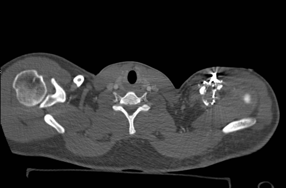 Clavicle Fracture due to Gun Shot Wound - CTisus CT Scan