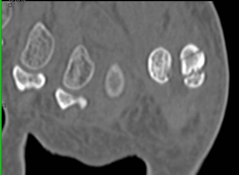 Sesamoid Fracture - CTisus CT Scan