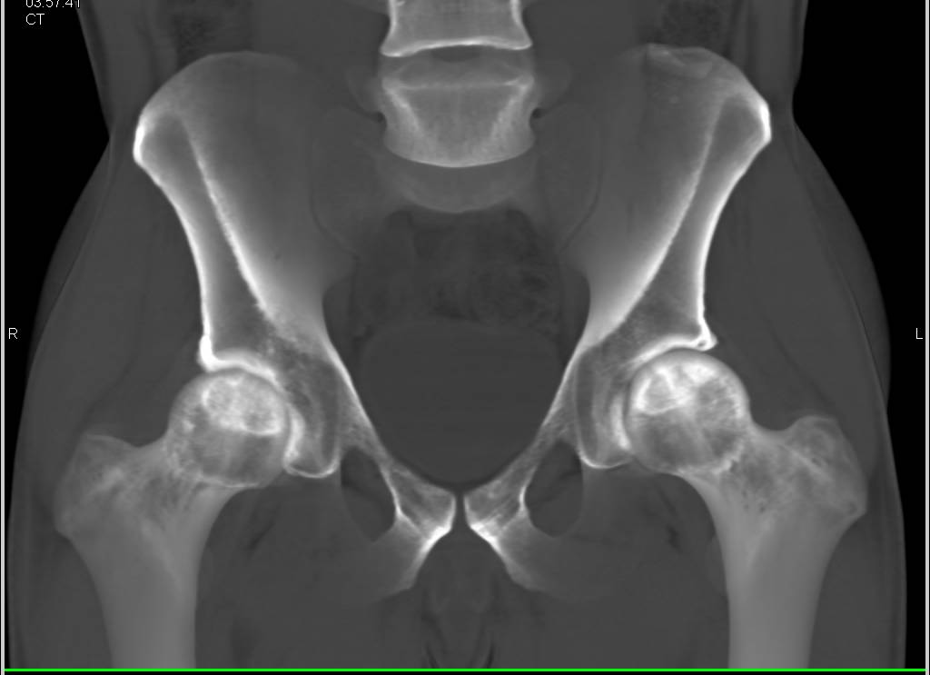 Avascular Necrosis of the Hips - CTisus CT Scan