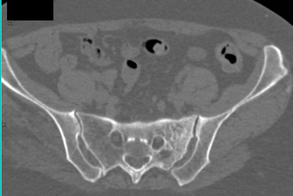 Stress Fracture of the Sacrum - CTisus CT Scan