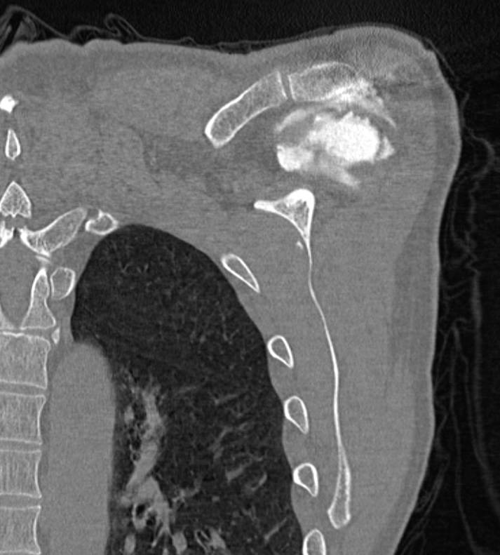 CT Arthrogram with Rotator Cuff Tear - CTisus CT Scan