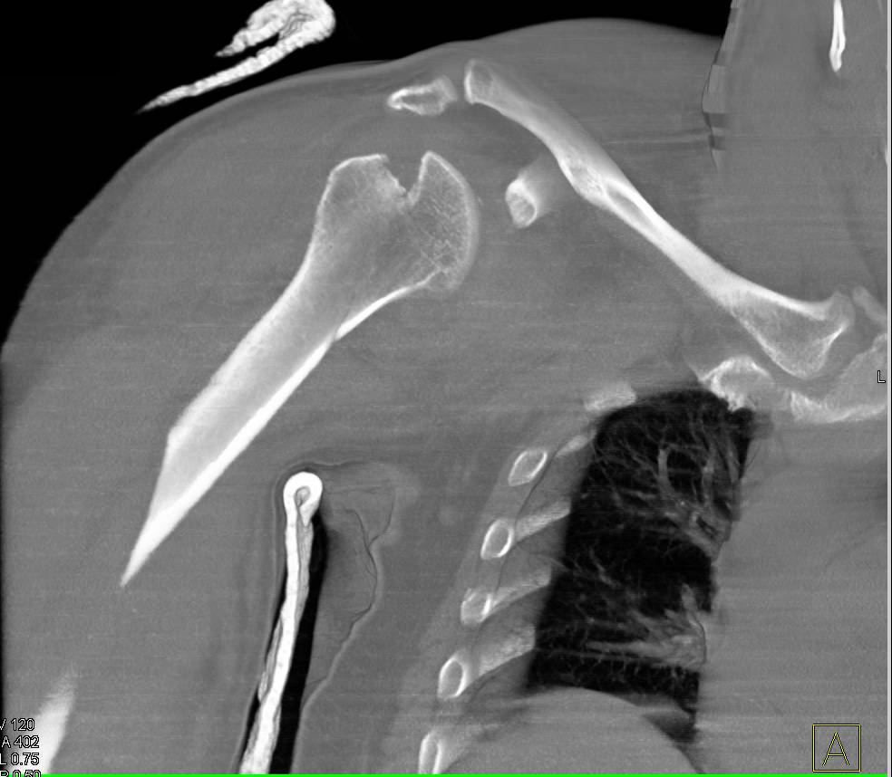 Fracture of the Humerus with Dislocation Reduced - CTisus CT Scan