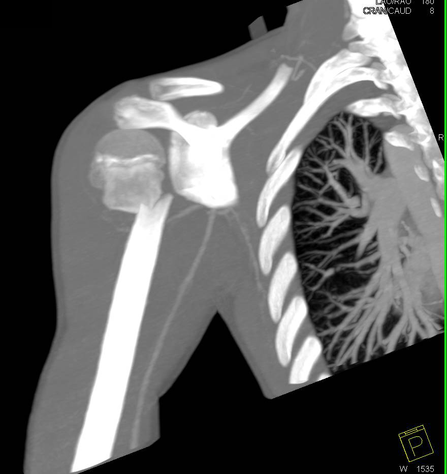 Humerus Fracture - CTisus CT Scan