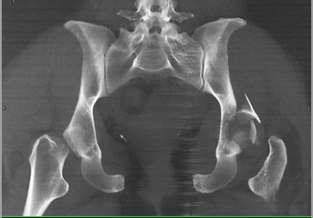 Acetabular Fracture with Hip Dislocation and Reduction - CTisus CT Scan