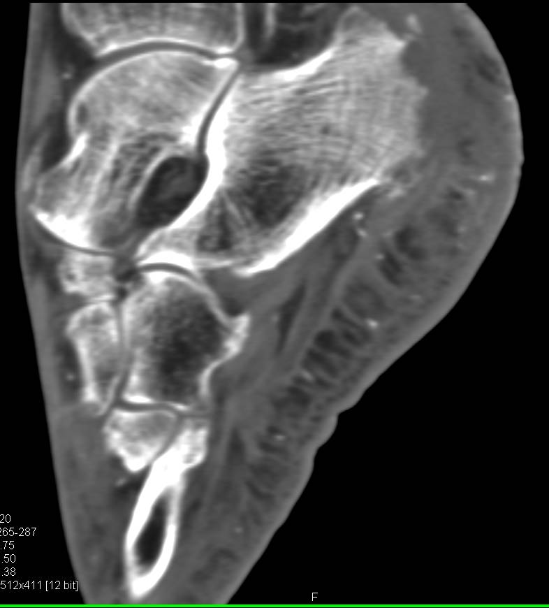 Inflammation with Erosive Changes of Calcaneus - CTisus CT Scan