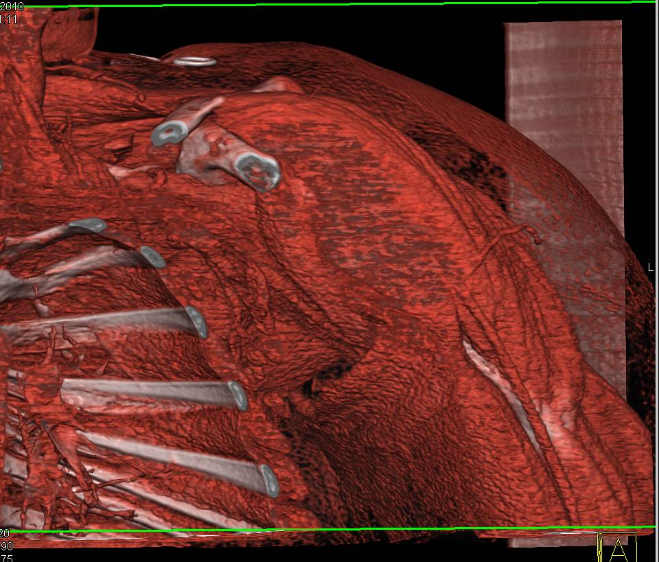 Fibrous Dysplasia - CTisus CT Scan