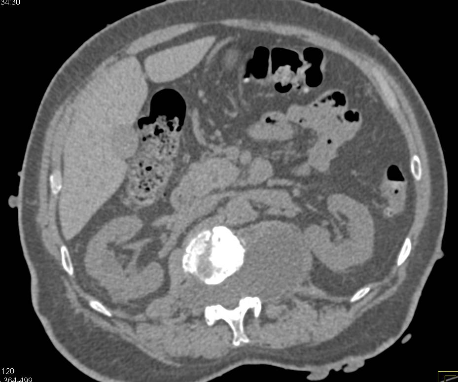 Neurofibromatosis with Especially Impressive Skin Lesion but also Spinal Lesions - CTisus CT Scan