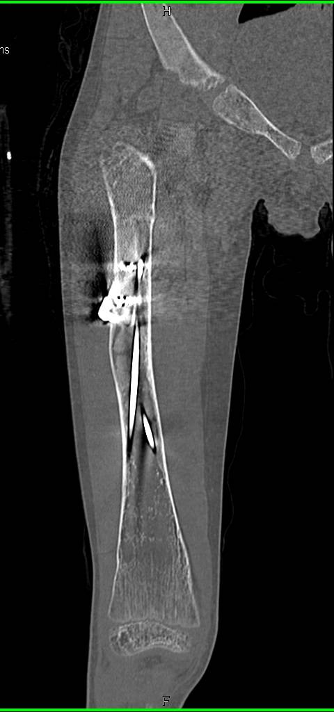 Fibrous Dysplasia Femur with Open Reduction Internal Fixation (ORIF) - CTisus CT Scan