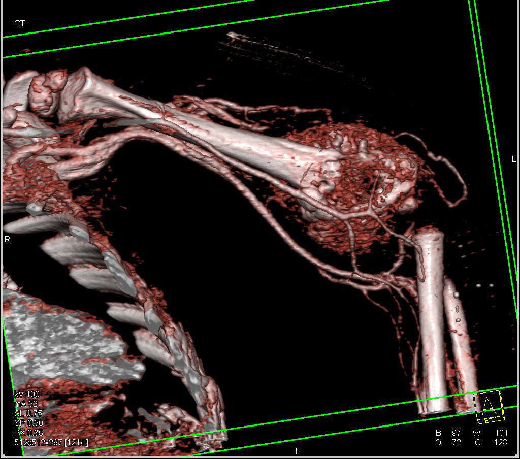 Ewing Sarcoma with Tumor Mass on CTA - CTisus CT Scan