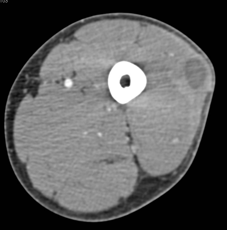 Thigh Abscess - CTisus CT Scan