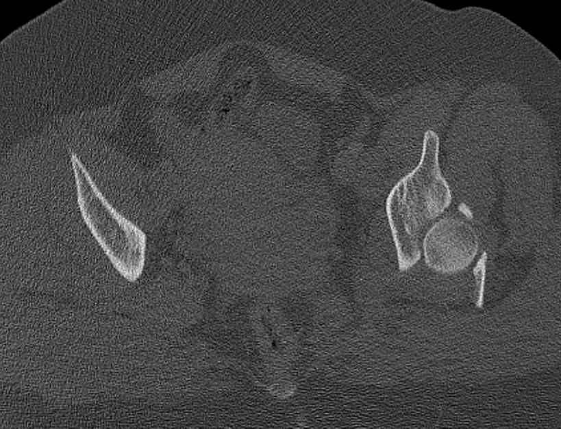 Acetabular Fracture with Hip Dislocation and Multiple 2D and 3D Perspectives - CTisus CT Scan