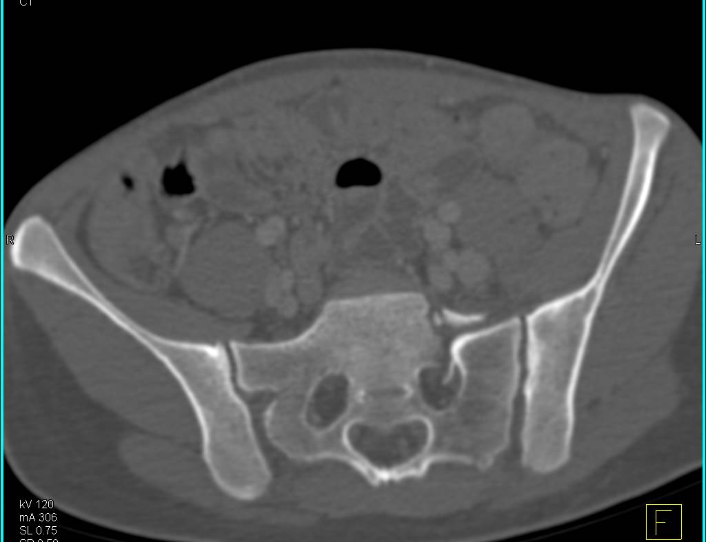 Sacral and Symphysis Fractures with Pelvic Hematoma in 3D Display - CTisus CT Scan