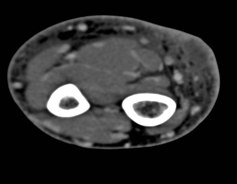 Cellulitis with Small Focal Abscess - CTisus CT Scan