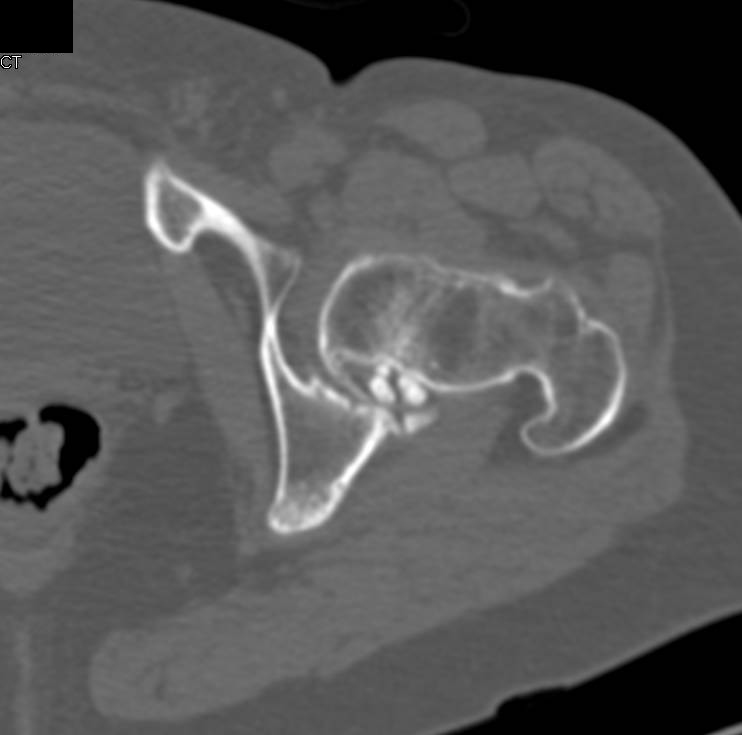 Patient with Joint Mice (left acetabulum) as well as Bone Infarcts - CTisus CT Scan