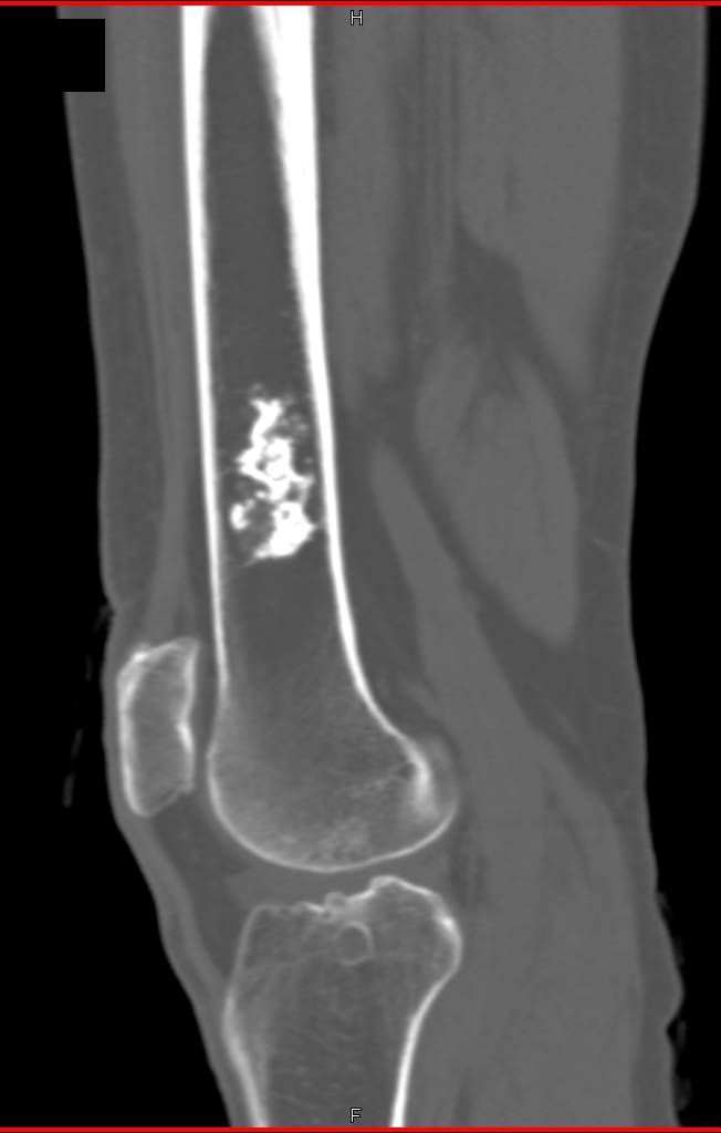 Patient with Joint Mice (left acetabulum) as well as Bone Infarcts