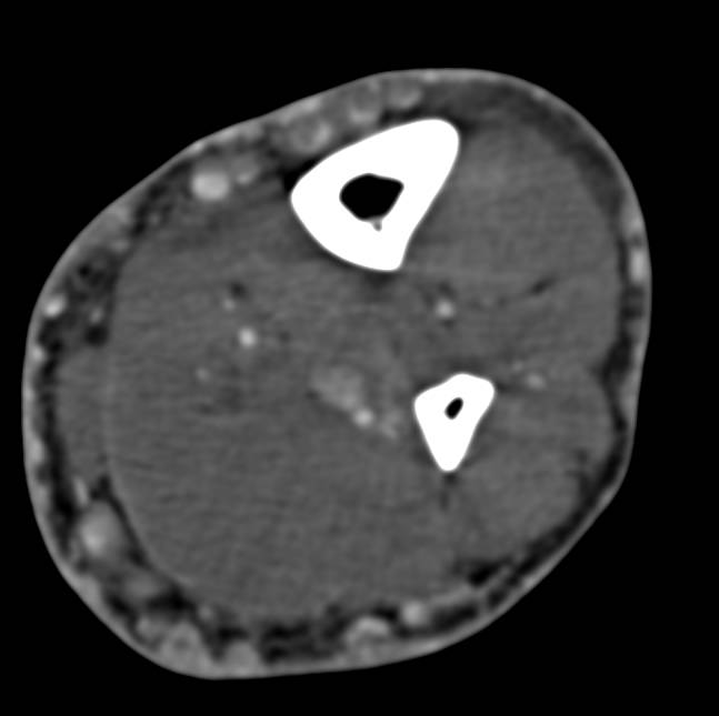 Cellulitis and Subcutaneous Collaterals in the Calf - CTisus CT Scan