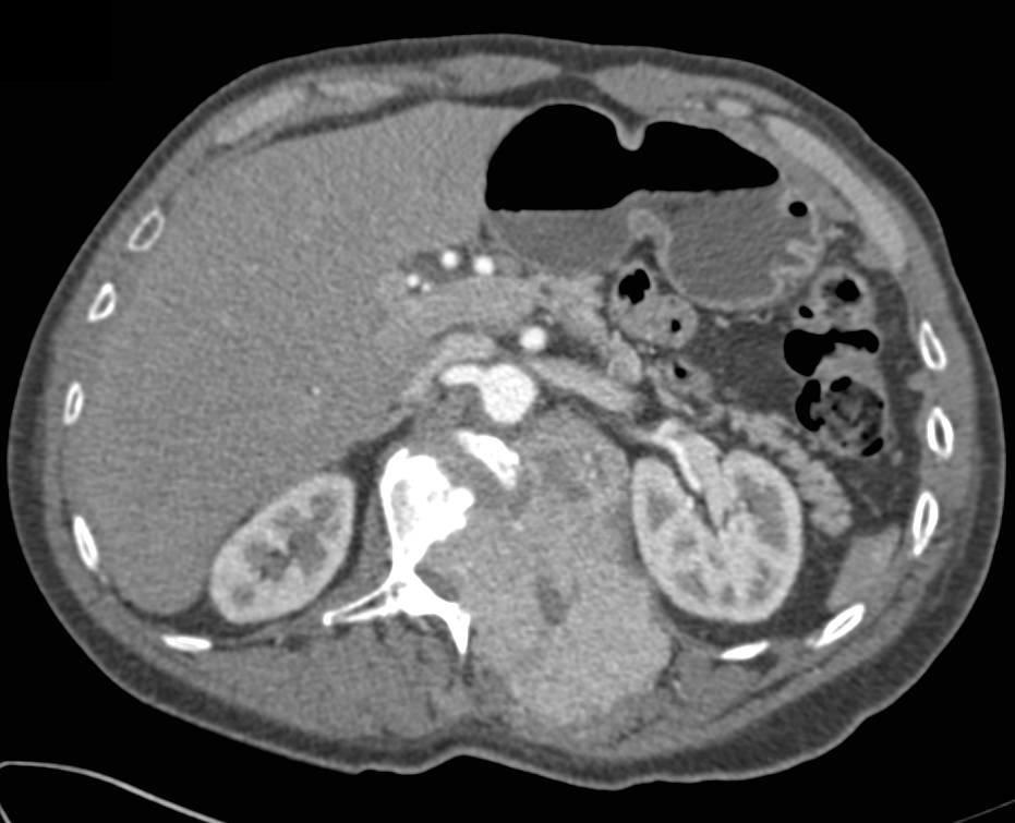 Hepatocellular Carcinoma (Hepatoma) Metastatic to Spine. Note the Metastatic Lesion is Vascular like the Primary Tumor - CTisus CT Scan