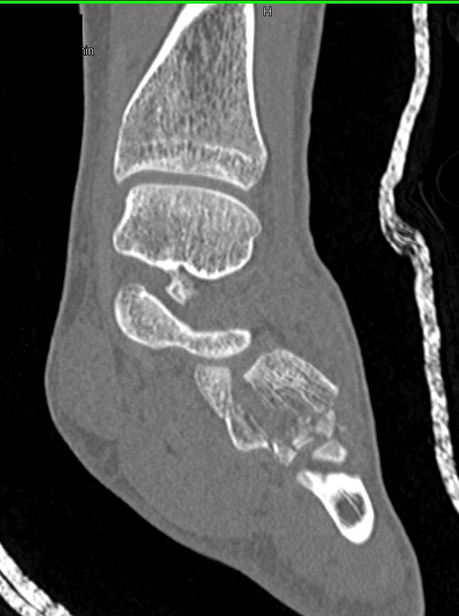 Midfoot Fractures - CTisus CT Scan