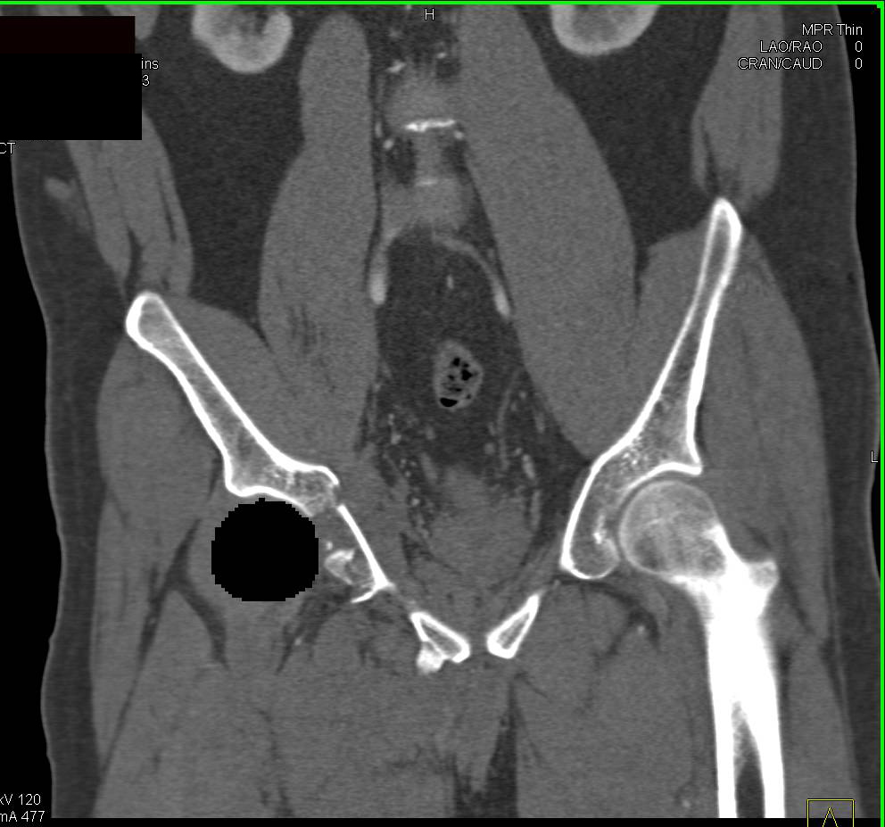 3D of Complex Acetabular Fracture with Femur Removal with Extensive Hematoma but No Evidence of Vascular Injury - CTisus CT Scan