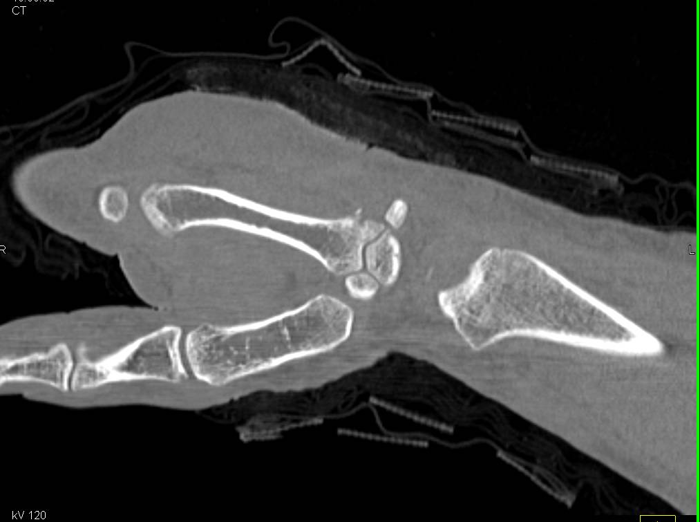 Trauma with Metacarpal and Carpal Fractures - CTisus CT Scan