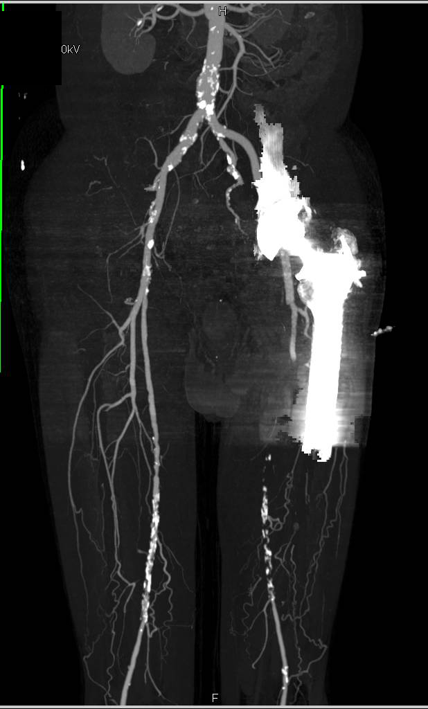 Runoff with Peripheral Vascular Disease and Artifact off a Total Hip Replacement (THR) - CTisus CT Scan