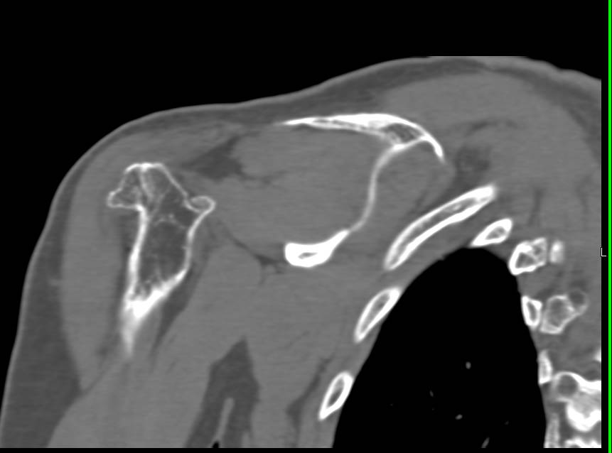 Deformed Humerus with Multiple Exostosis - CTisus CT Scan