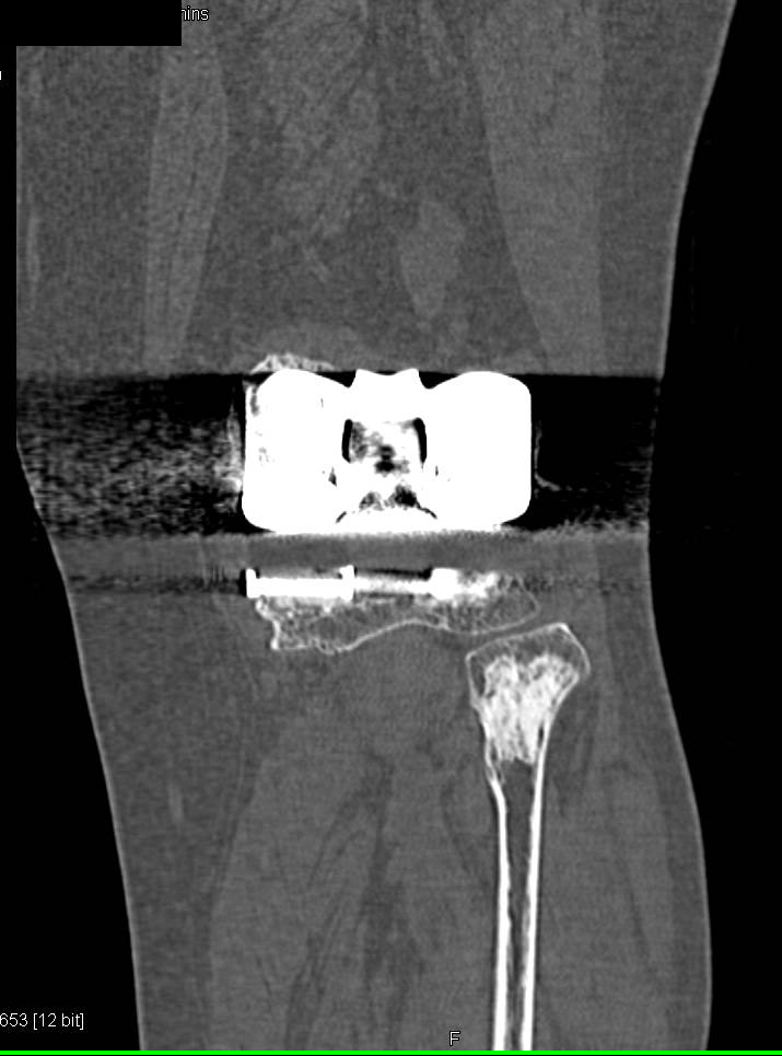 Total Knee Replacement in 3D - CTisus CT Scan