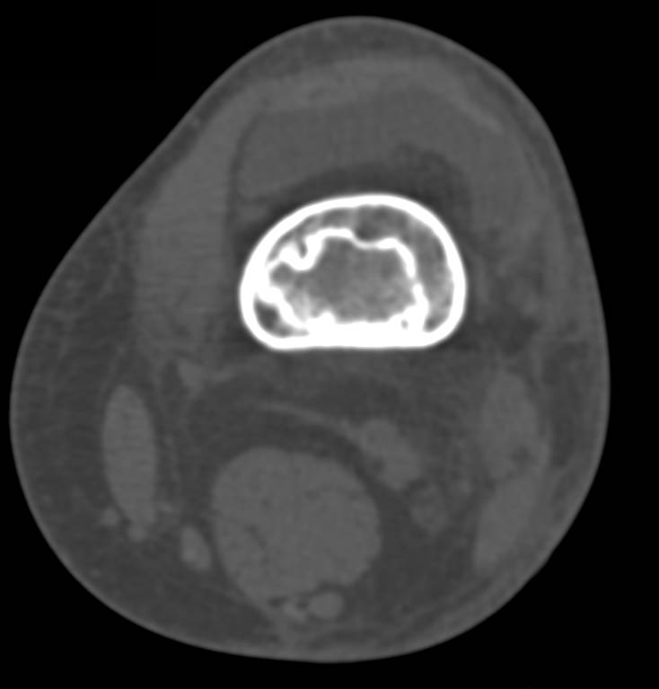 Bone Infarcts in the Distal Femur - CTisus CT Scan