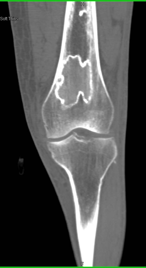 Bone Infarcts in the Distal Femur Musculoskeletal Case