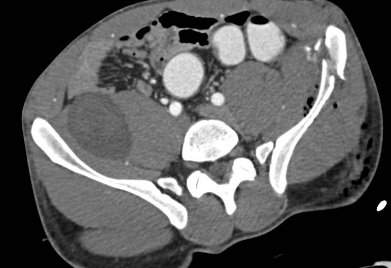 Pelvic Fracture in a Patient with Neurofibromatosis - CTisus CT Scan