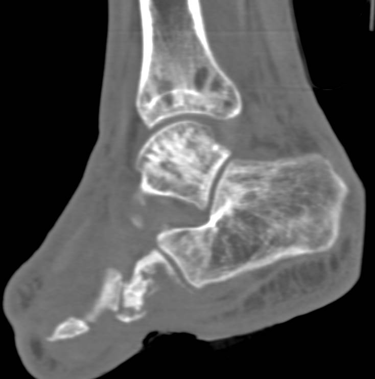 Osteomyelitis Involves the Calcaneus and the Cuboid - CTisus CT Scan