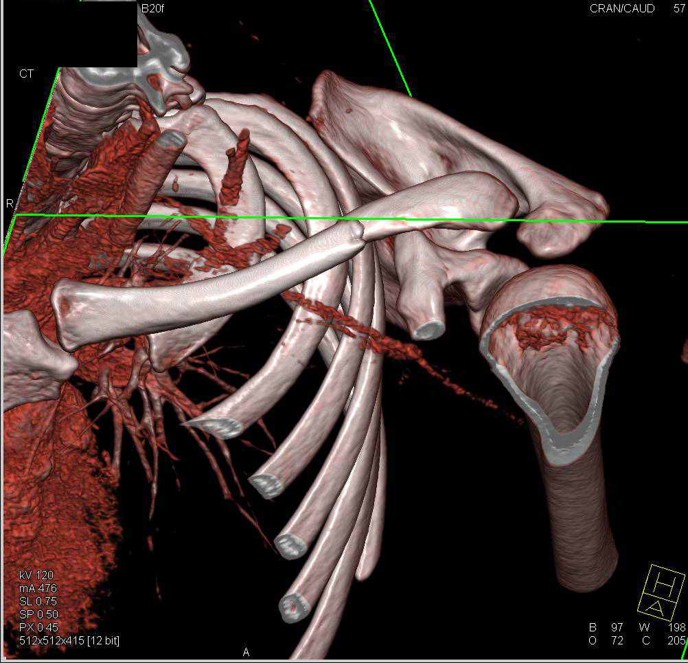 Clavicle Fracture - CTisus CT Scan