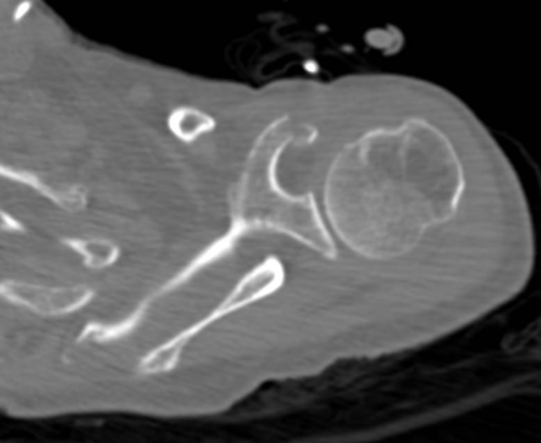 Scapular fracture - CTisus CT Scan