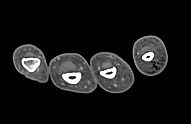 Gas Gangrene in the 5th Digit - CTisus CT Scan