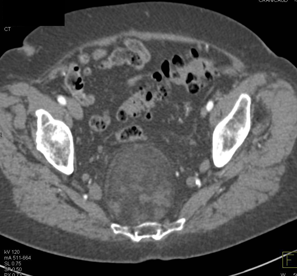 Presacral Liposarcoma - CTisus CT Scan