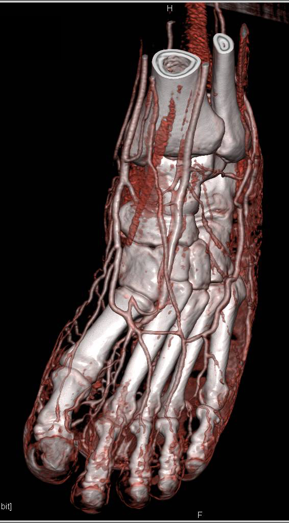 CTA of the Foot - CTisus CT Scan