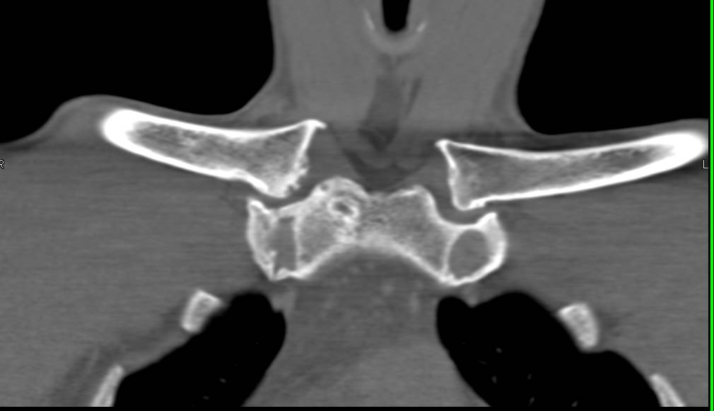 Trauma to Right Sterno-Clavicular Joint - CTisus CT Scan