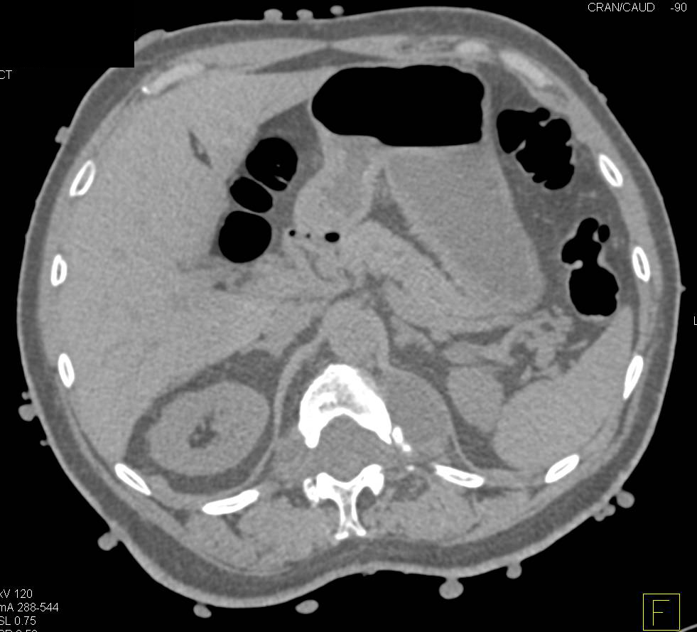 Incredible Case of Neurofibromatosis - CTisus CT Scan